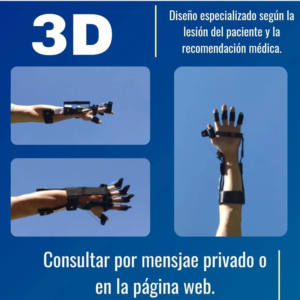 Férulas dinámicas de mano y dedos impresas en 3D por Férulas Tuc, colocadas sobre una mano